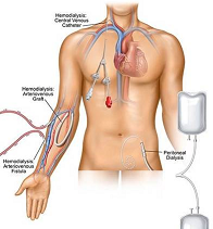 Vascular Access For CKD Patients